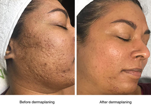 dermaplaning-image